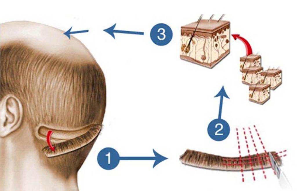 Cách điều trị hói đầu bằng phương pháp cấy tóc