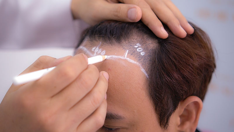 Cấy tóc để trị rụng tóc androgen